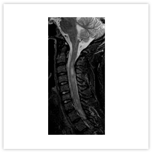 Рисунок 5. МРТ головного мозга
пациента с ОНМ: очаг патологического накопления контрастного вещества в дорзаль ном отделе продолговатого мозга с распространением на area postrema