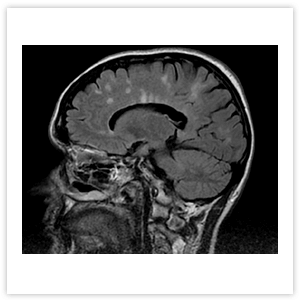Рисунок 4. МРТ головного мозга пациента с РС: множественные очаги демиелинизации в лобной,
теменной и затылочной долях, расположенные около коры и желудочков головного мозга